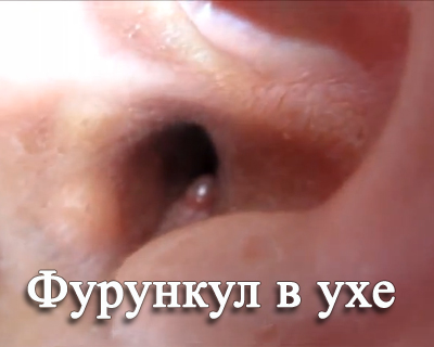 Лечение фурункула уха у детей